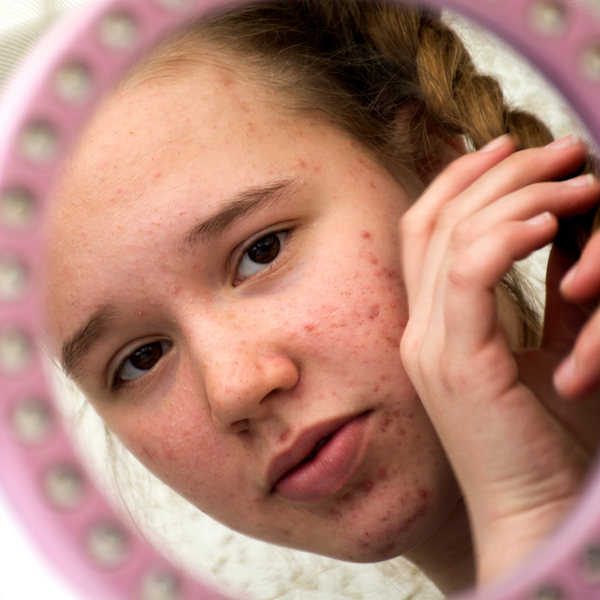 June Acne Awareness Month